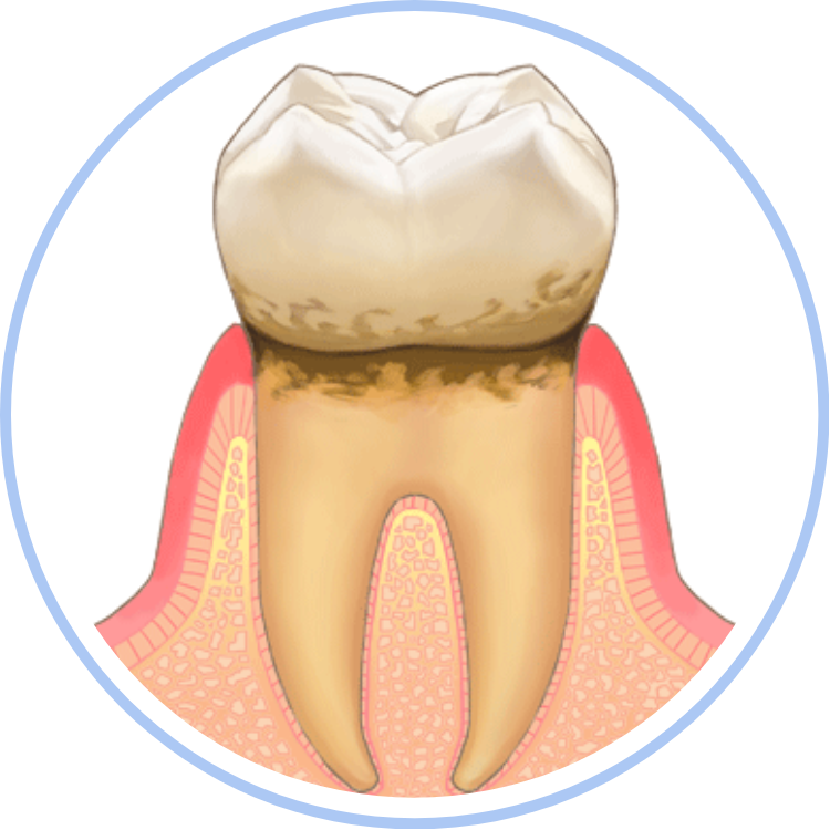 軽度歯周炎
