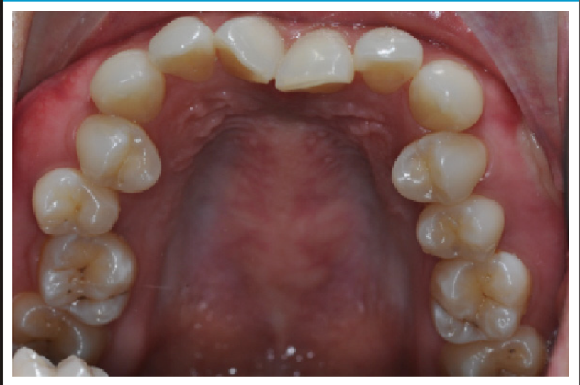 叢生非抜歯症例before
