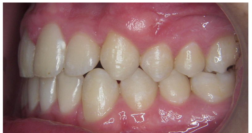 混合歯列期症例after