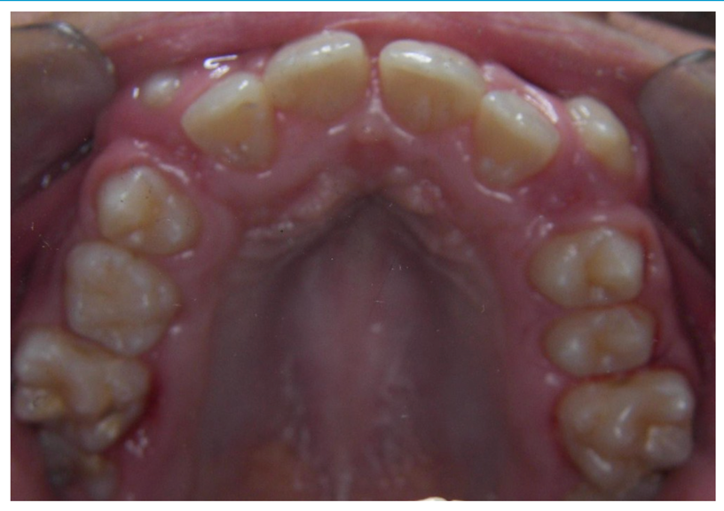 混合歯列期症例before