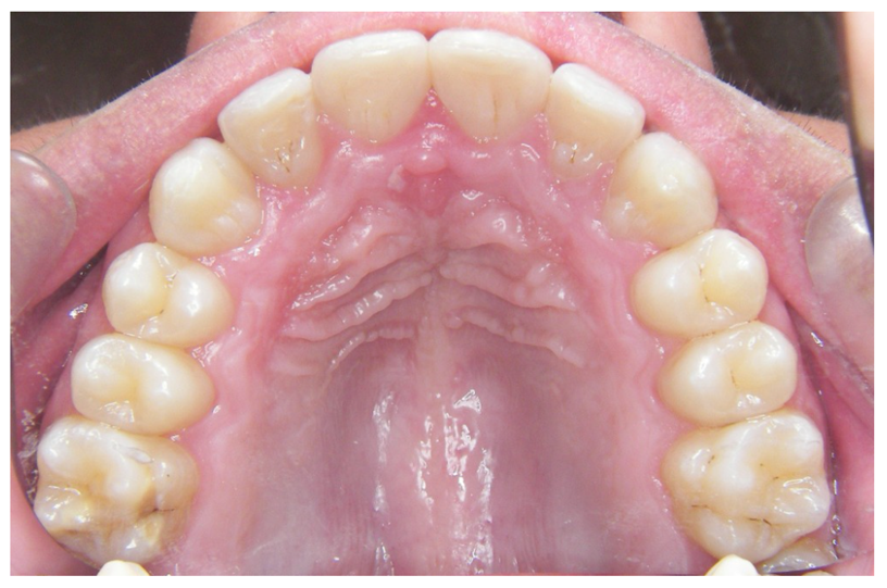 歯列期症例after