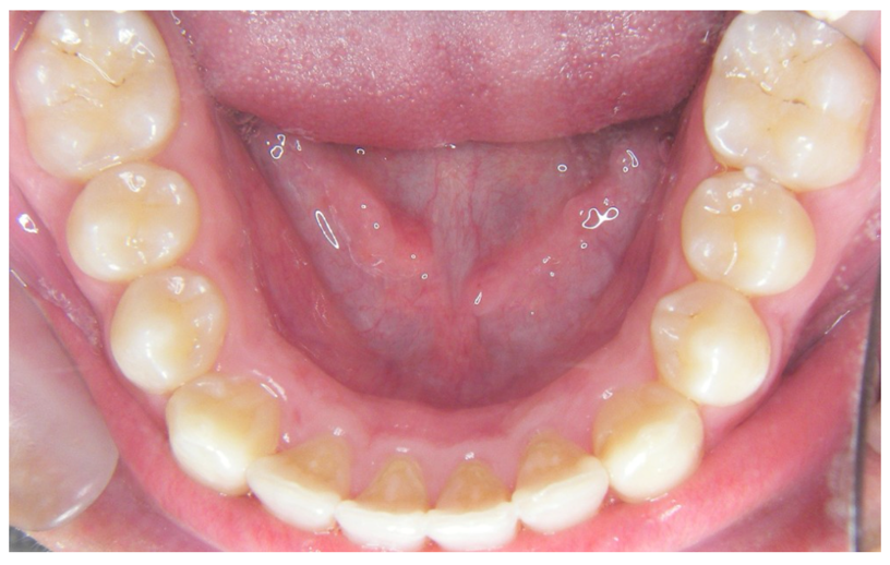 混合歯列期症例after