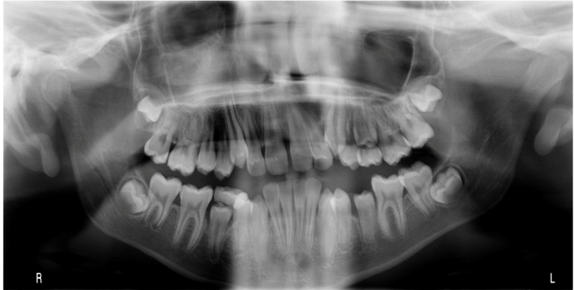 混合歯列期症例before