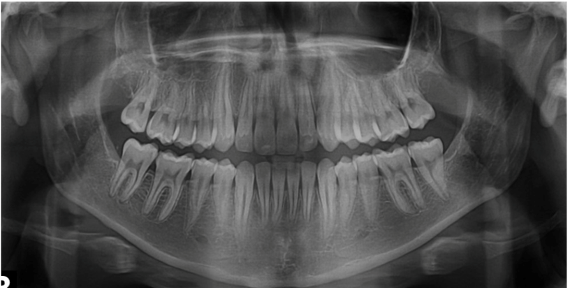 混合歯列期症例レントゲンafter